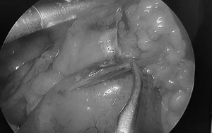 Hóc xương cá, nam trung niên nguy kịch vì bị thủng thực quản, tràn mủ màng tim