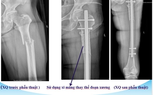 Đổ "xi măng" cứu chân cho bệnh nhân ung thư di căn xương 