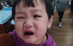 Bé gái 24 tháng tuổi méo miệng, liệt mặt vì đi chơi tối lạnh