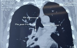 Ngậm vỏ quả chữa ho, một nam giới bị dị vật gây tắc phế quản