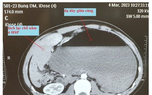 Xoắn dạ dày khiến thanh niên đau chướng bụng, buồn nôn nhiều ngày