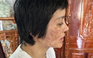 Vụ người vợ mang bầu &quot;tố&quot; bị chồng bạo hành dã man: Hội Liên hiệp Phụ nữ tỉnh Hải Dương vào cuộc