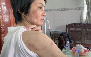 Hải Dương: Vợ bầu 7 tháng tố bị chồng bạo hành được giám định trên cơ thể có 200 vết thương 