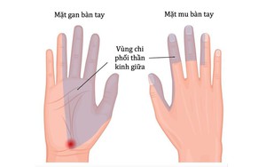 Tay tê rần, đau nhức, coi chừng hội chứng ống cổ tay