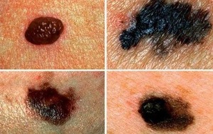 5 dấu hiệu nhận biết nốt ruồi ác tính, có nguy cơ ung thư tế bào hắc tố