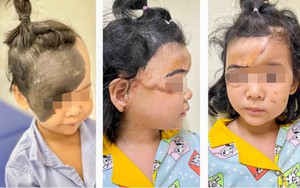 3 năm, 3 lần phẫu thuật "giải cứu" khuôn mặt cho cô bé bị u hắc tố khổng lồ