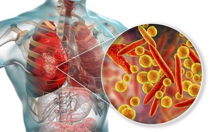 Cảnh giác với bệnh viêm phổi do vi khuẩn, dễ lây, biến chứng nguy hiểm