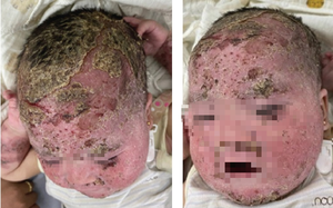 Bé trai 8 tháng bong tróc toàn bộ đầu, mặt vì gia đình tắm lá chữa viêm da cơ địa