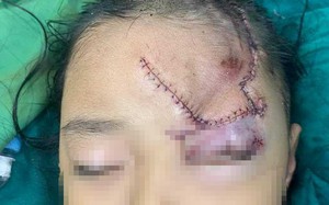Nghệ An: Bé gái 5 tuổi bị chó tấn công, cắn nát phần mặt