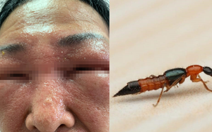 Cặp vợ chồng suýt mù mắt khi dính nọc độc của loại côn trùng độc hơn rắn hổ mang 