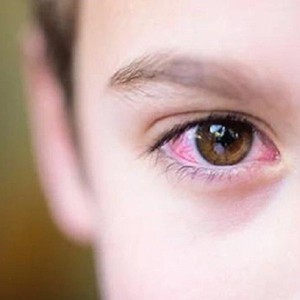 Dịch đau mắt đỏ đang lây lan nhanh, làm thế nào để phòng ngừa?