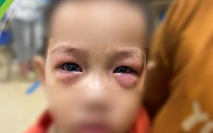 Hàng chục trẻ đau mắt đỏ nhập viện, chuyên gia cảnh báo biến chứng nặng