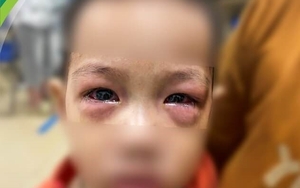 Trẻ đau mắt đỏ gia tăng, nhiều ca biến chứng nặng đến viêm kết mạc có giả mạc