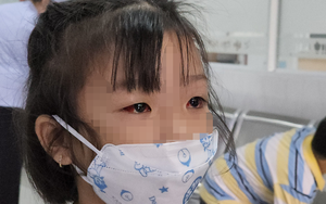 Hơn 71.000 ca đau mắt đỏ, Sở Y tế TP.HCM khẩn trương tìm tác nhân gây bệnh