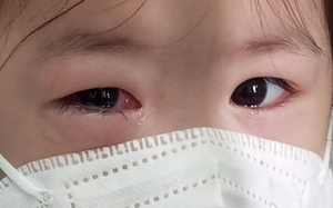Vì sao hơn 71.000 người dân TP.HCM bị đau mắt đỏ?