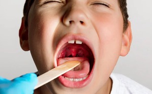 Trẻ viêm amidan đến mức nào thì nên đi cắt? 