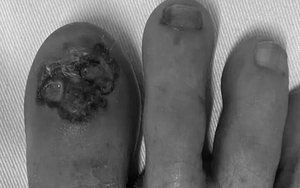 Ngón chân đen nhánh, lở loét vì ung thư da nguy hiểm
