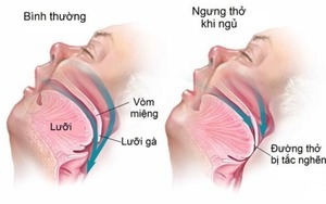 Cảnh giác với bệnh thường gặp trong mùa "thoắt nóng thoắt lạnh"- Ảnh 4.