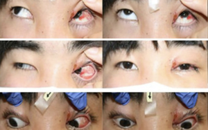 Chàng trai 19 tuổi mắc chứng rối loạn mắt hiếm gặp sau khi bị chó cắn