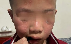 Hà Nội: Nhiều học sinh mẩn ngứa, rát mắt sau khi nhà trường phun thuốc diệt muỗi