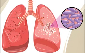 Bị chó cắn chỉ tiêm phòng uốn ván, 1 tháng sau, bé trai sợ nước, sợ gió - Ảnh 5.