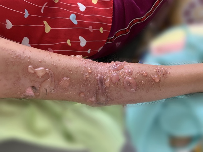 Bé gái 8 tuổi bị sứa &quot;cắn&quot; phải nhập viện - Ảnh 1.