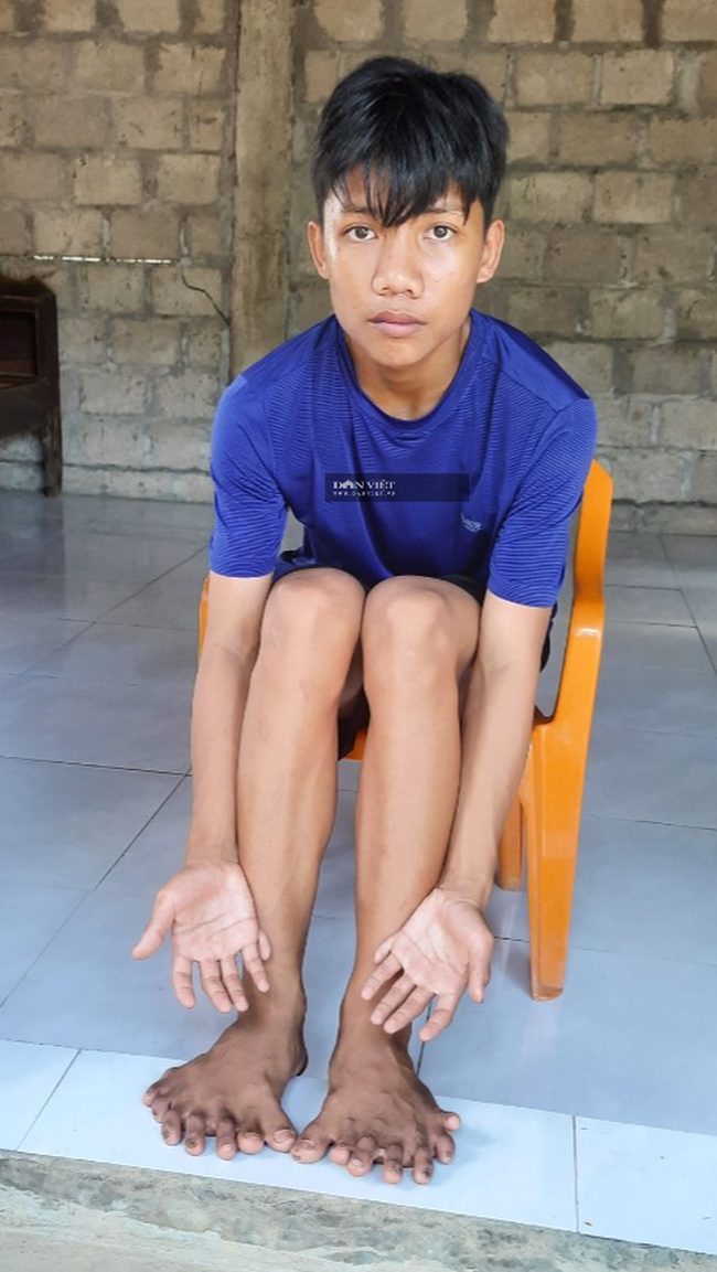 Cậu bé nghèo có 26 ngón chân tay ở Quảng Trị và ước mơ được phẫu thuật - Ảnh 1.