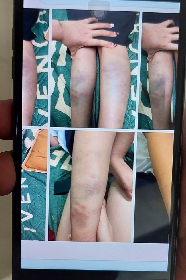 Không khởi tố vụ án hình sự vụ học sinh tiểu học bị đánh bầm tím chân tay ở trường - Ảnh 1.