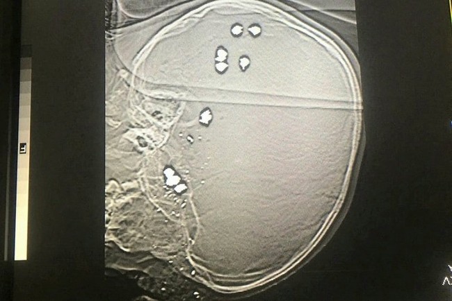Xót xa bé trai 6 tuổi bị 11 viên đạn găm vào đầu tử vong - Ảnh 2.