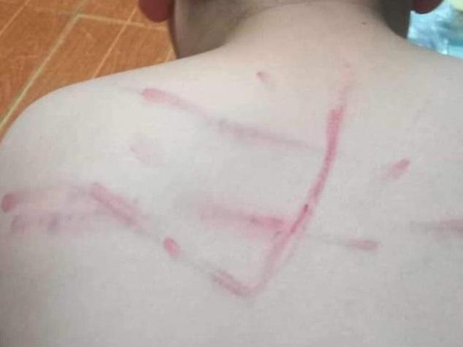 Học sinh lớp 4 bị cô giáo đánh bầm tím vì không làm bài tập: &quot;Cháu nói bị ngã nhưng thái độ có bất thường&quot; - Ảnh 1.