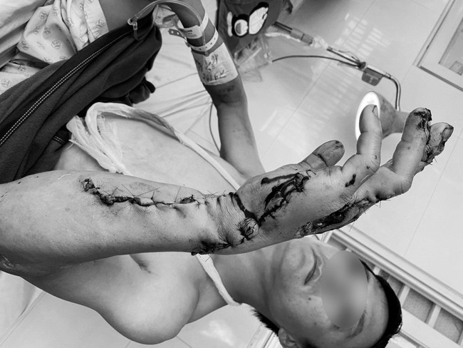 Phẫu thuật khẩn trong đêm cứu cánh tay bị máy cưa nghiền nát - Ảnh 1.