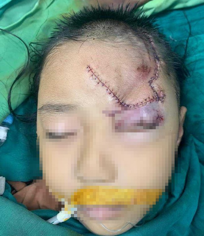 Bé gái 5 tuổi bị chó tấn công, cắn nát phần mặt, mất hẳn một vùng da lớn - Ảnh 1.
