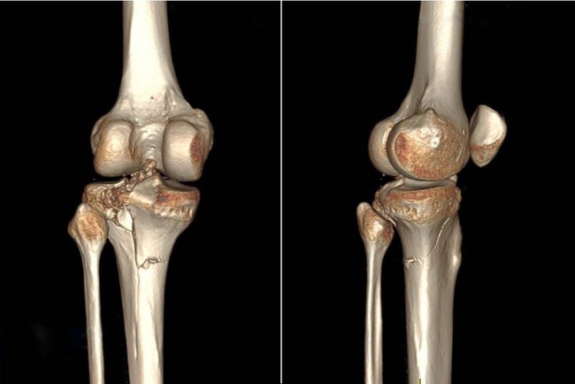  Bệnh nhân Ấn Độ bị vỡ mâm chày gối, sau 3 ngày phẫu thuật kết hợp xương sinh học được xuất viện - Ảnh 1.