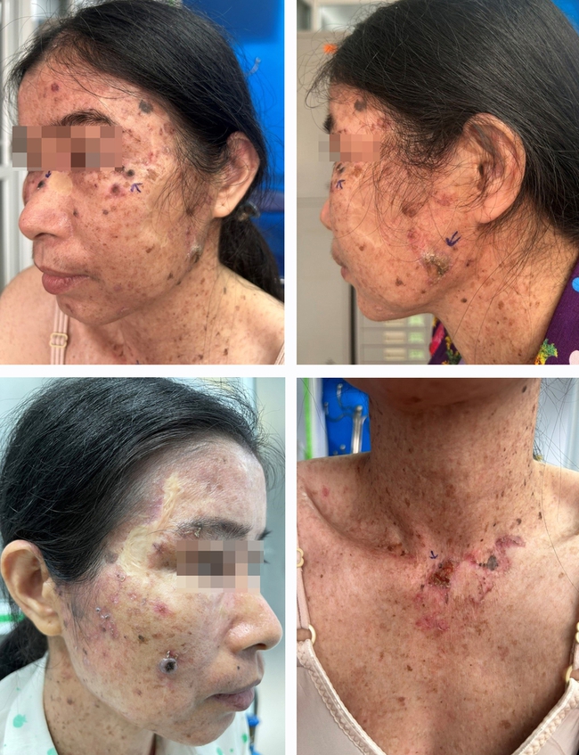 Mọc &quot;hạt cơm&quot; rải rác toàn thân từ thời thiếu nữ, trung niên phát triển thành ung thư da - Ảnh 1.