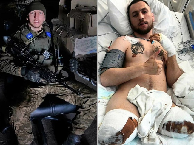 Điều kinh hoàng nhất ám ảnh những người lính Ukraine phải cắt cụt tay chân trong chiến tranh - Ảnh 2.