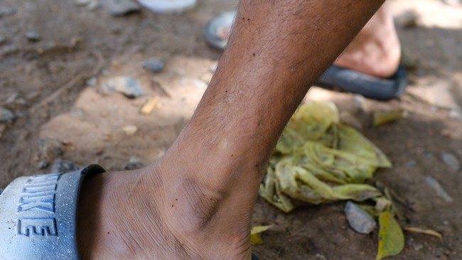 Nhiều người ở Tây Ninh, nhất là trẻ em, bị côn trùng lạ cắn gây mẩn ngứa khắp cơ thể- Ảnh 2.