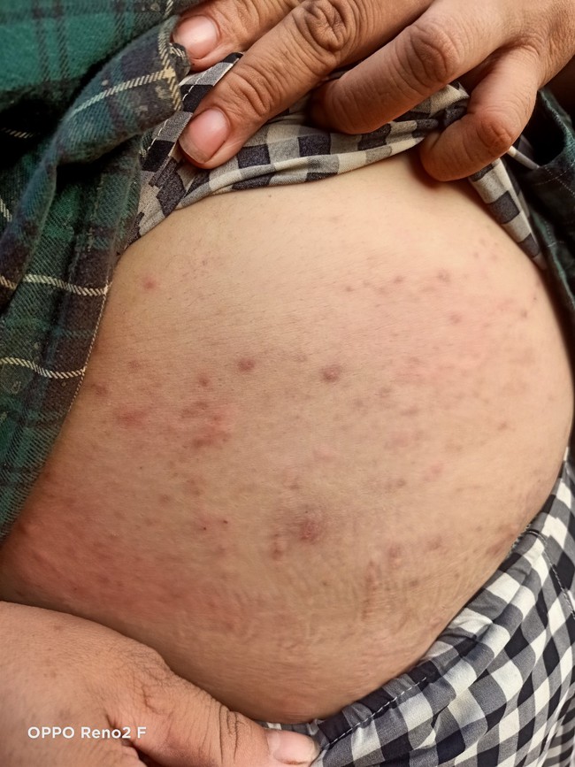 Nhiều người ở Tây Ninh, nhất là trẻ em, bị côn trùng lạ cắn gây mẩn ngứa khắp cơ thể- Ảnh 1.