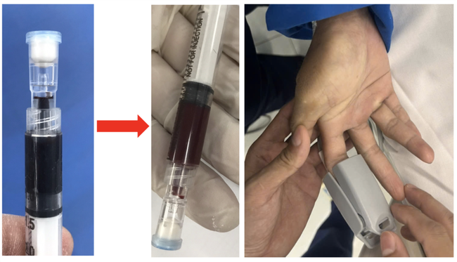 TP.HCM: Hai bệnh viện chia sẻ thuốc quý, hiếm cứu sống 2 bệnh nhân ngộ độc Methemoglobin nặng - Ảnh 1.