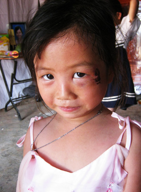 Dù chẳng gây ra tội gì nhưng đứa trẻ 6 tuổi này lại bị bố đánh rách mắt, bầm mặt.