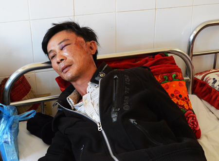 Anh Đỗ Vạn Hoa với nhiều vết thương ở mặt đang được điều trị tại Bệnh viện Đa khoa tỉnh Đăk Lăk.