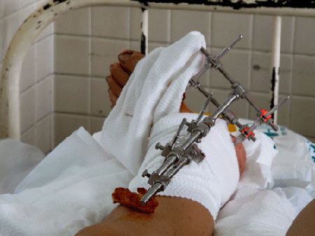 Một ca nối chân thành công của Bệnh viện Chợ Rẫy TPHCM khi bàn chân bị máy cắt cỏ cắt đứt.