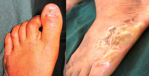 Móng chân cái bị mất móng và mép bàn chân bị bỏng nặng.