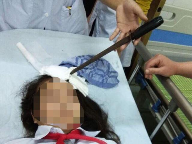 Nữ sinh bị bạn học phi dao cắm thẳng trán
