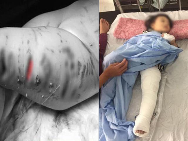 Bé gái 2 tuổi bị chó Pitbull giật đứt xích lao vào cắn