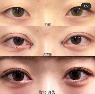 Nhật Bản và Hàn Quốc là hai quốc gia đi đầu trong lĩnh vực phẫu thuật thẩm mỹ mắt. Và phẫu thuật thẩm mỹ mắt \