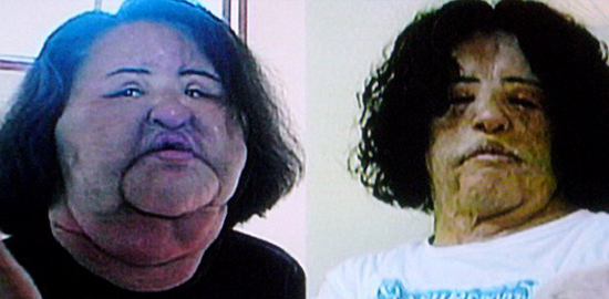 Hang Mioku's face was left so swollen by the silicone and cooking oil, left, that has own parents did not recognise her. Despite 10 operations her face is still severely disfigured, right
