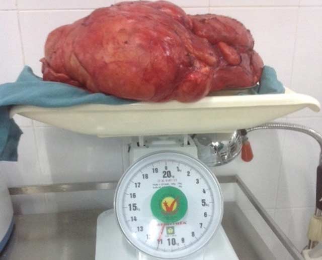 Ông Xuân trước khi phẫu thuật; khối u nặng khoảng 11kg.