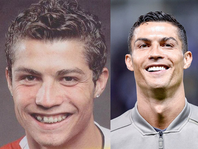 CR7, Beckham, Ronaldinho... điển trai hơn nhờ thẩm mỹ, sửa răng