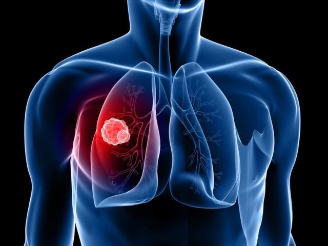”Thần dược” không mất tiền giảm đến 77% nguy cơ ung thư phổi