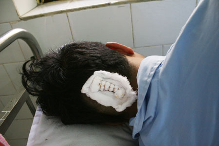 Anh Xuân nằm điều trị tại Bệnh viện đa khoa Thái Bình với vết thương sau đầu.